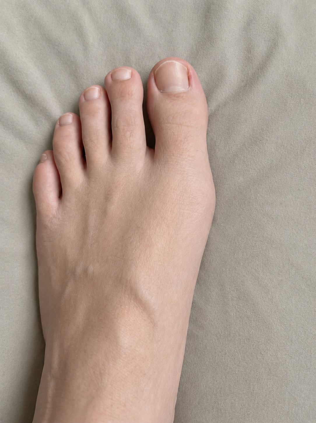 Before — bunion untreated