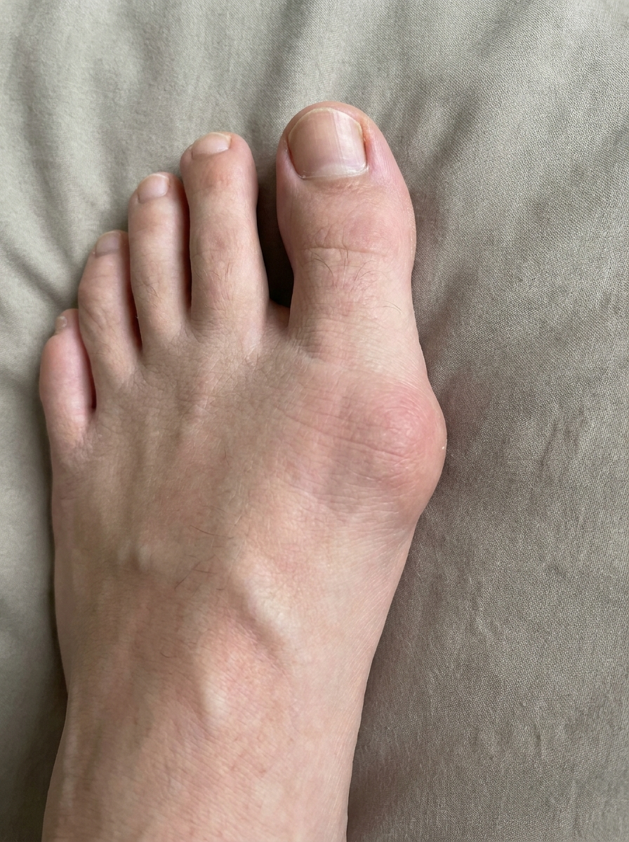 After — bunion treated